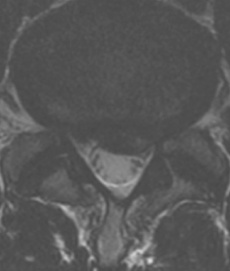 herniated disk