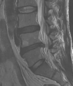 disk herniation in lower back