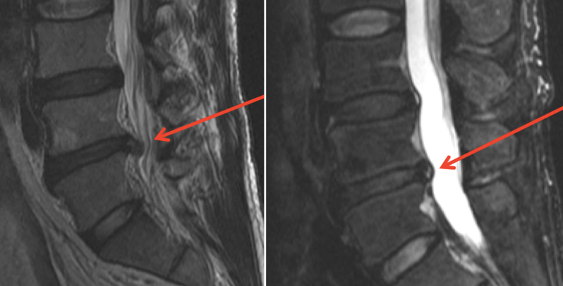 x-rays before and after prolotherapy