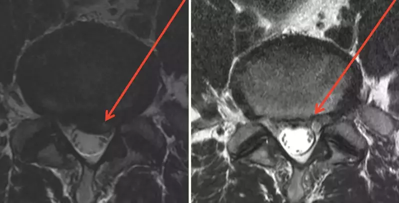 before and after prolotherapy