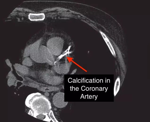 Coronary Artery Calcium (CAC) score