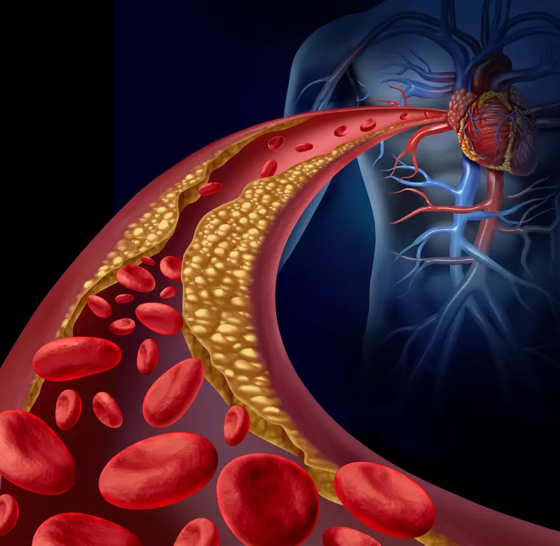 tulsa functional cardiology Lp-PLA2