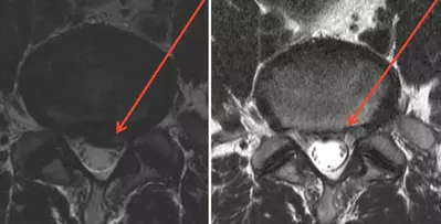 low back herniated disk transverse before and after prolotherapy cure