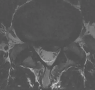 low back herniated disk before prolotherapy transverse